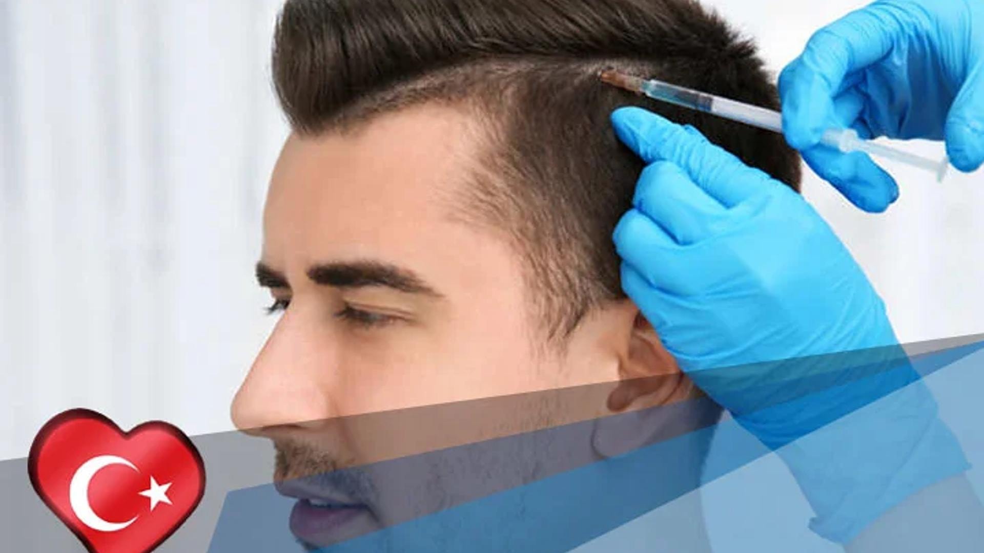 Haartransplantatie in Turkije